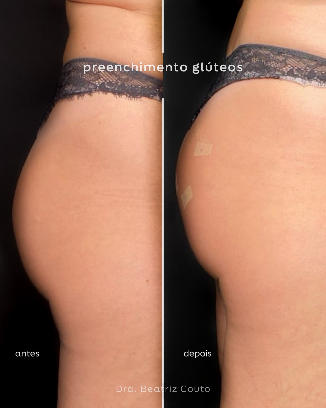 Preenchimento de Glúteos 01