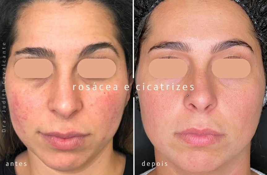 Rosácea e Acne