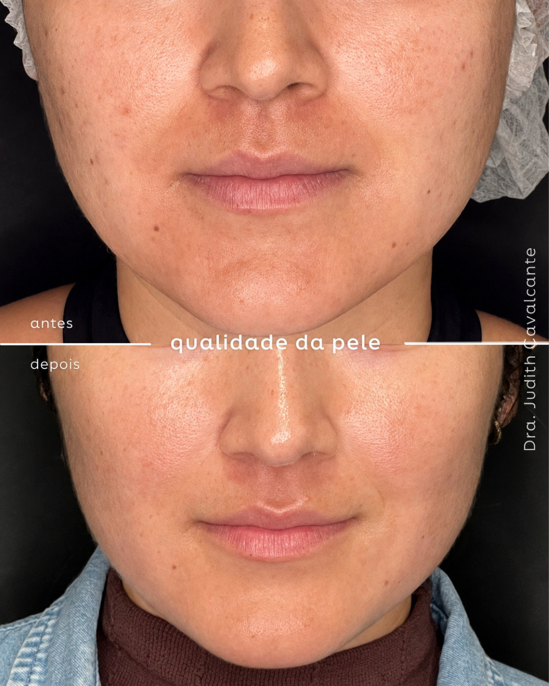 Acne e Cicatrizes 01