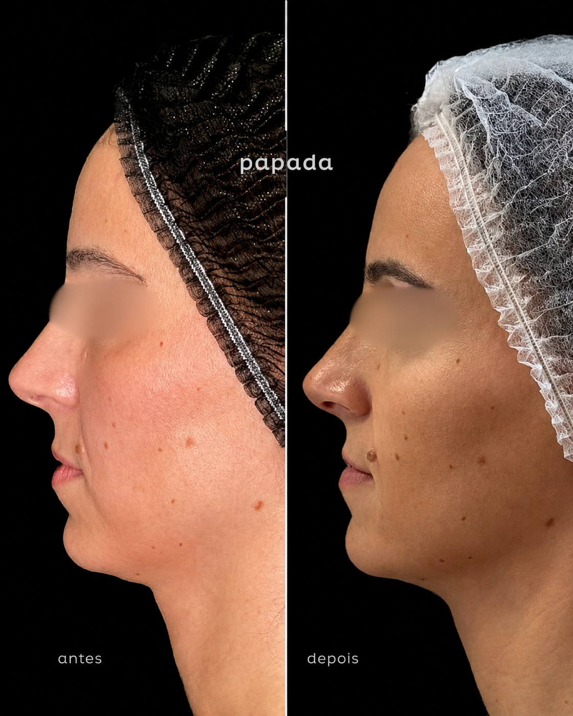 Papada 01