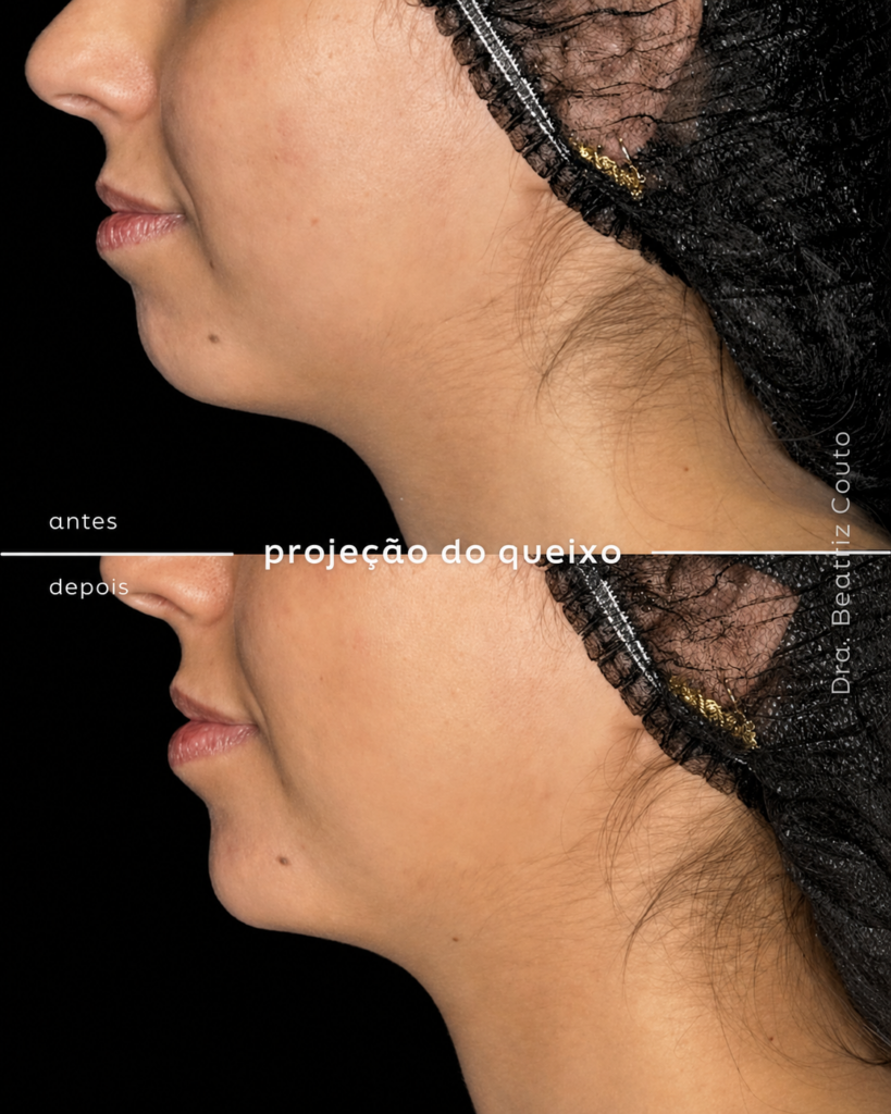 Projeção do queixo 03
