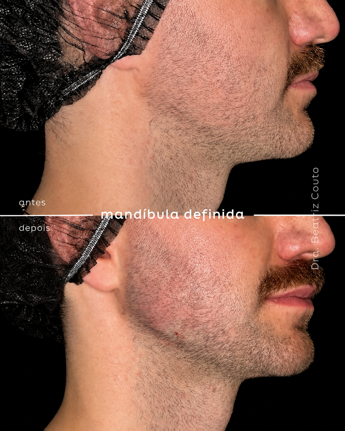 Preenchimento Mandibular 02