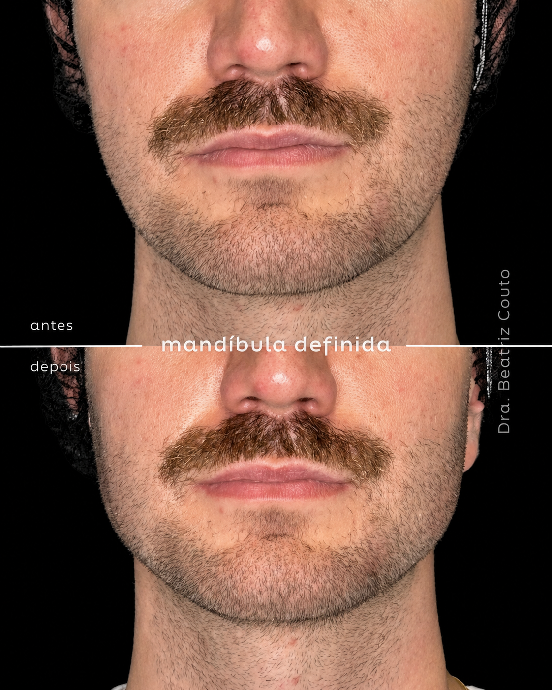 Preenchimento Mandibular 01