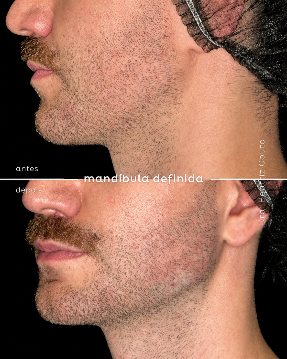 Preenchimento Mandibular 03