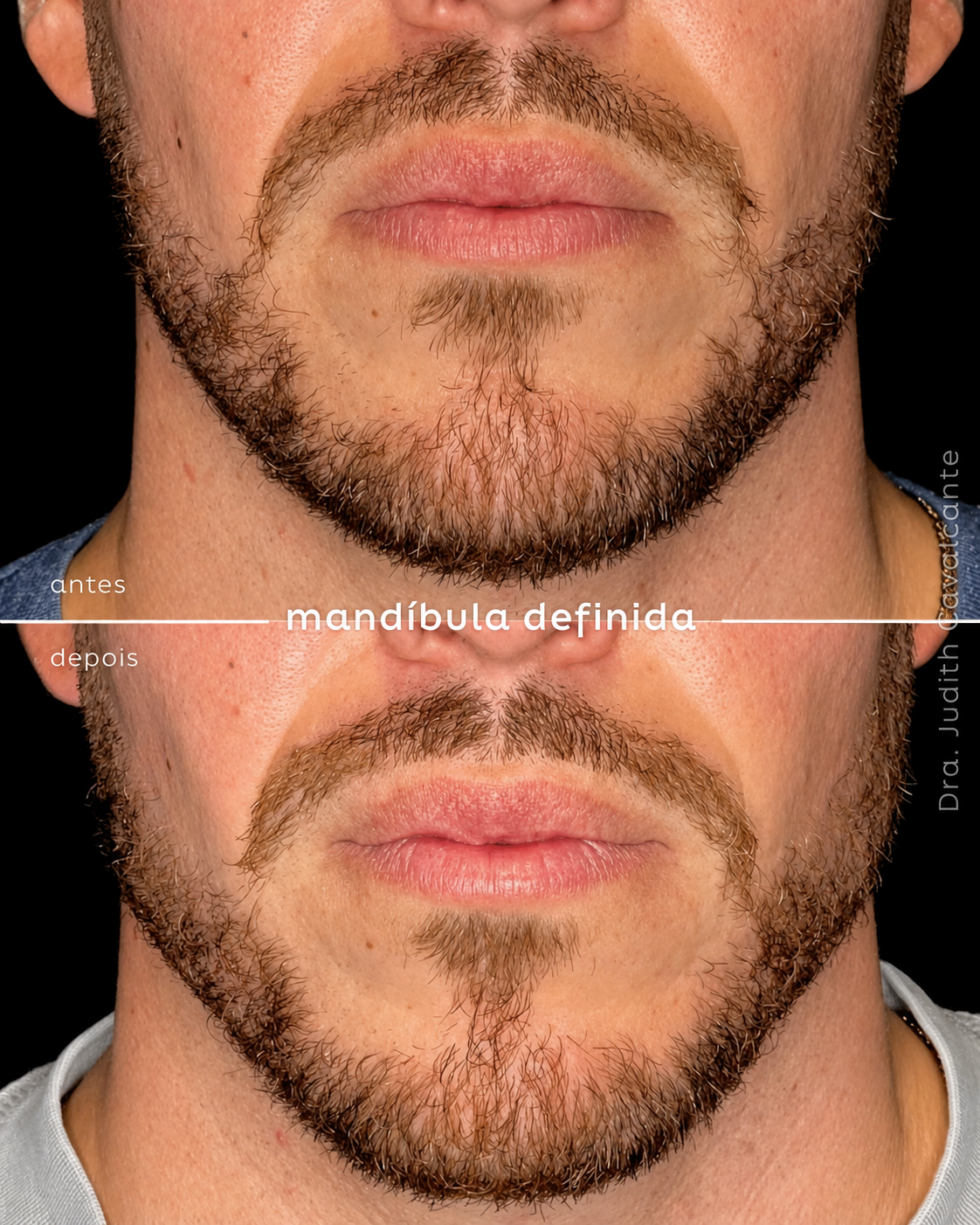 Preenchimento Mandibular 04