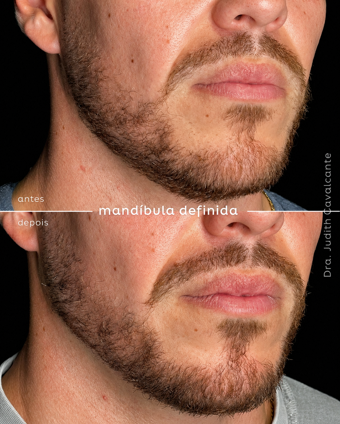 Preenchimento Mandibular 05
