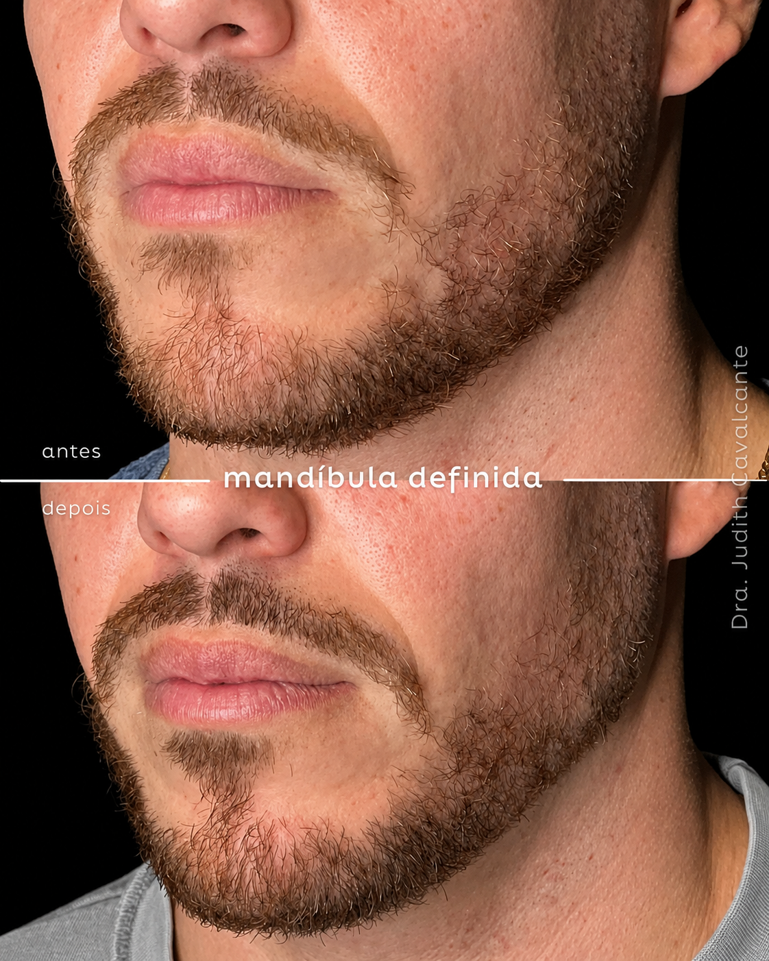 Preenchimento Mandibular 06