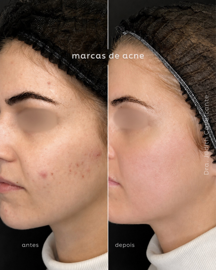 Acne mulher adulta