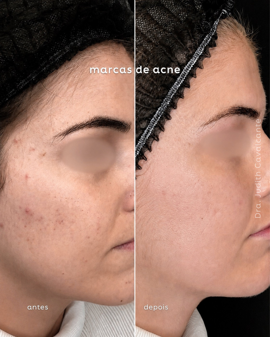 Acne mulher adulta 02