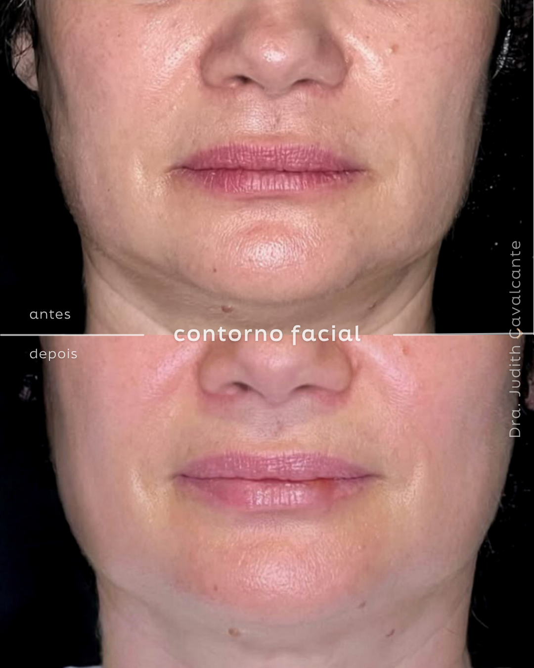 Contorno facial 01