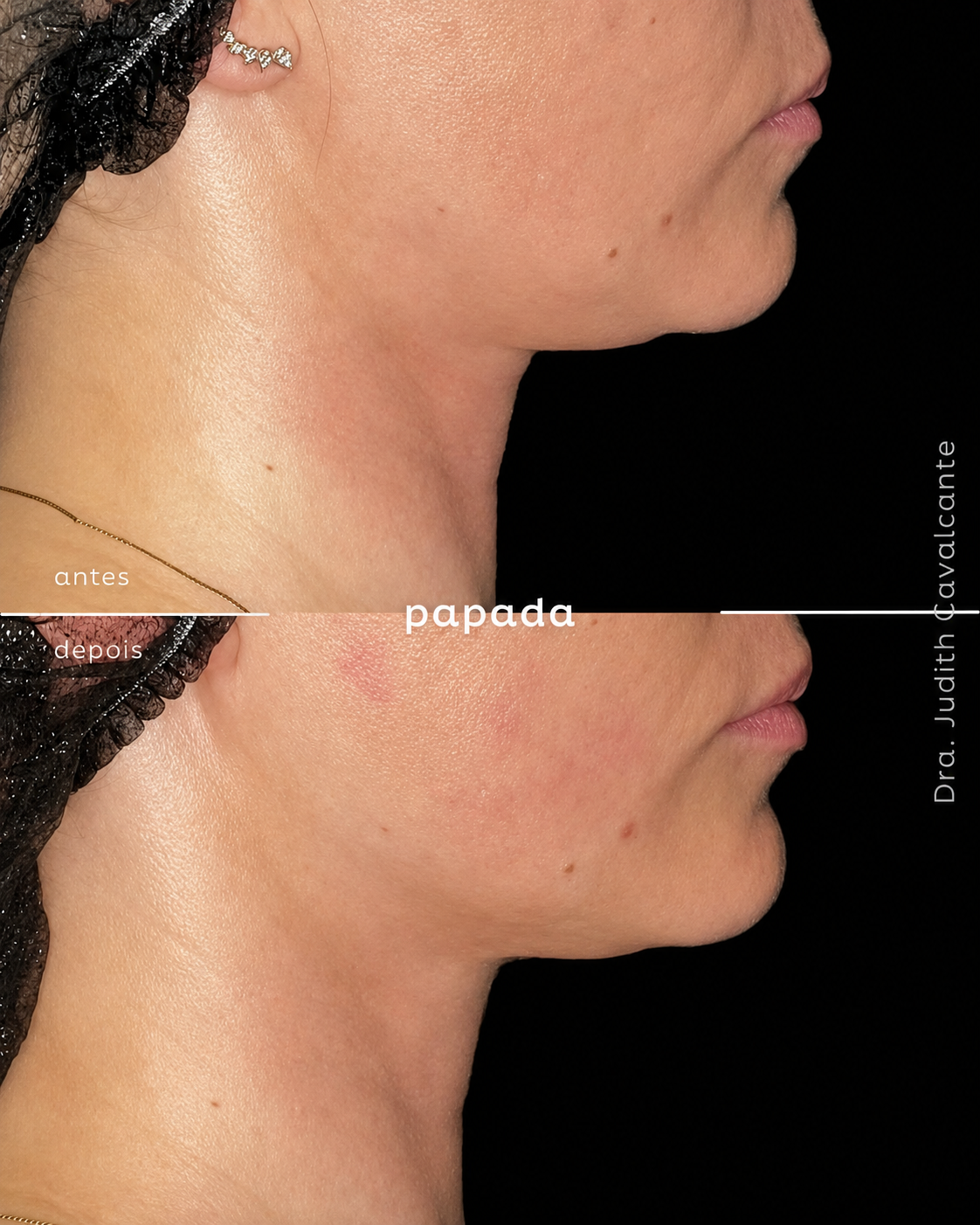 Papada 04