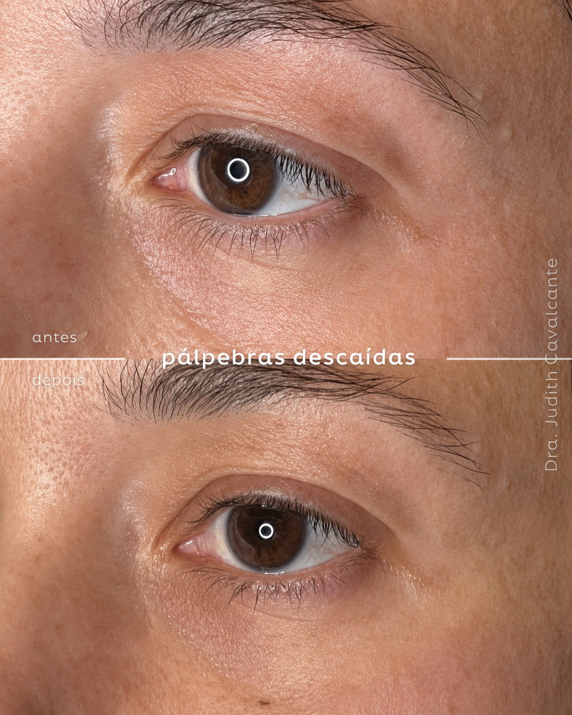 Pálpebras Descaídas 01