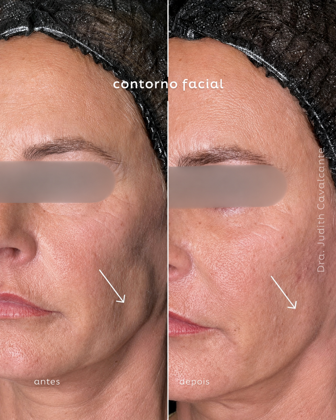 Contorno facial 04