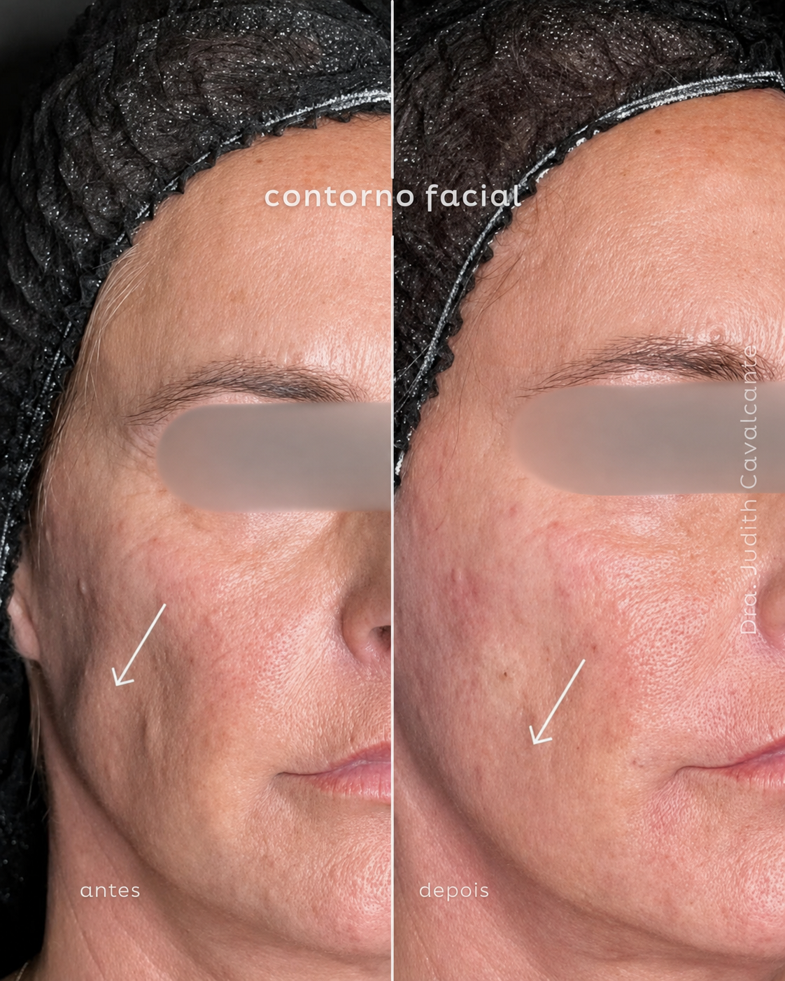 Contorno facial 05
