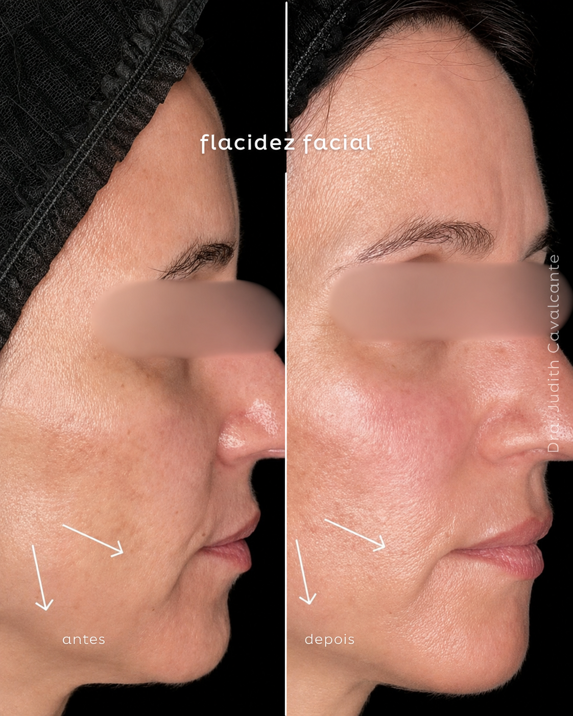 Flacidez Facial 01