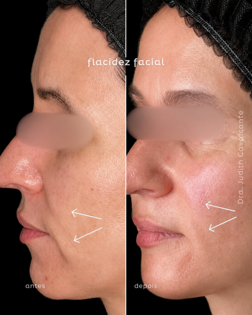 Flacidez Facial 02