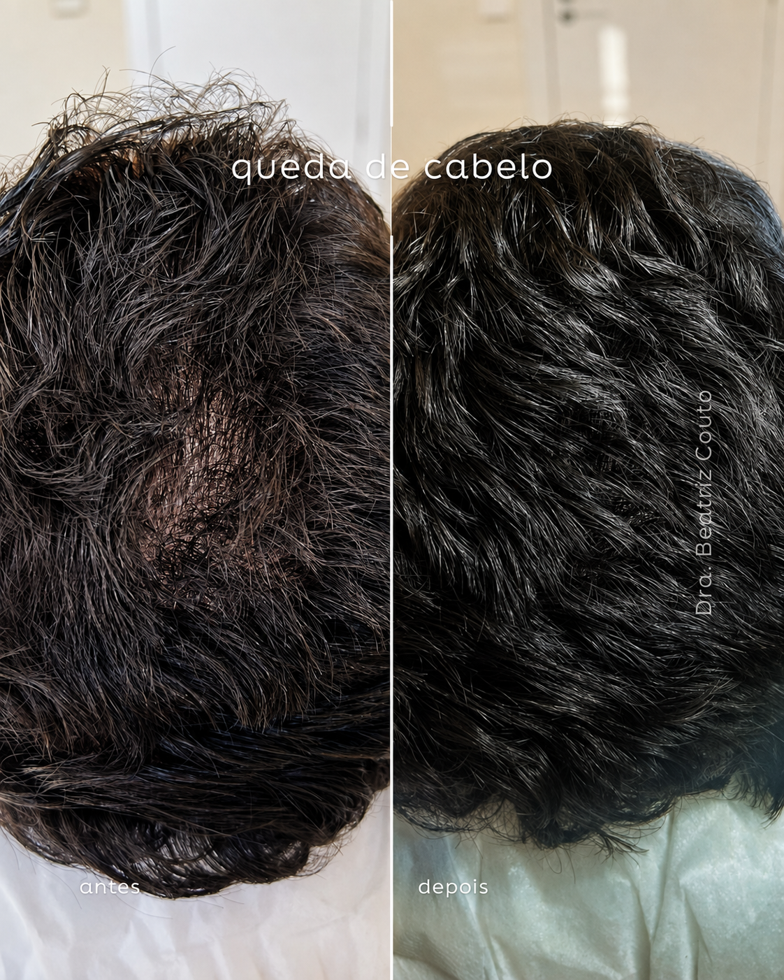Queda de cabelo 01