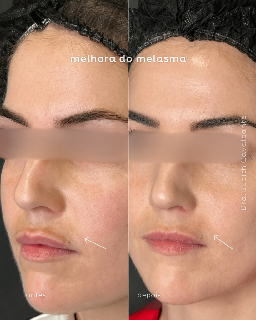 Tratamento Melasma