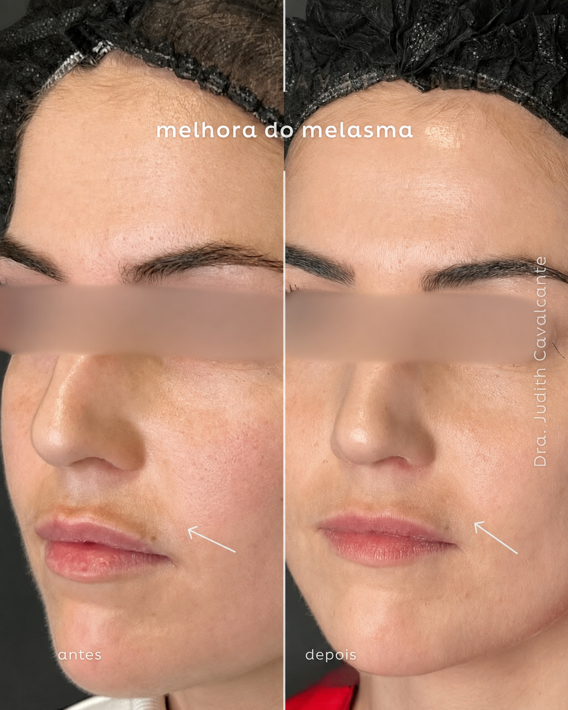 Tratamento Melasma
