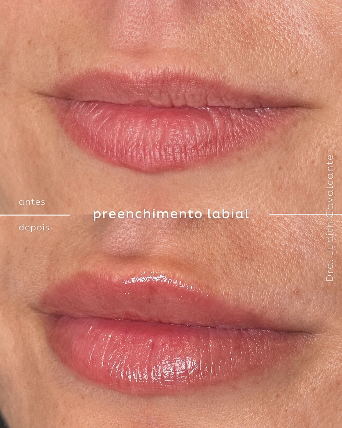 Preenchimento labial