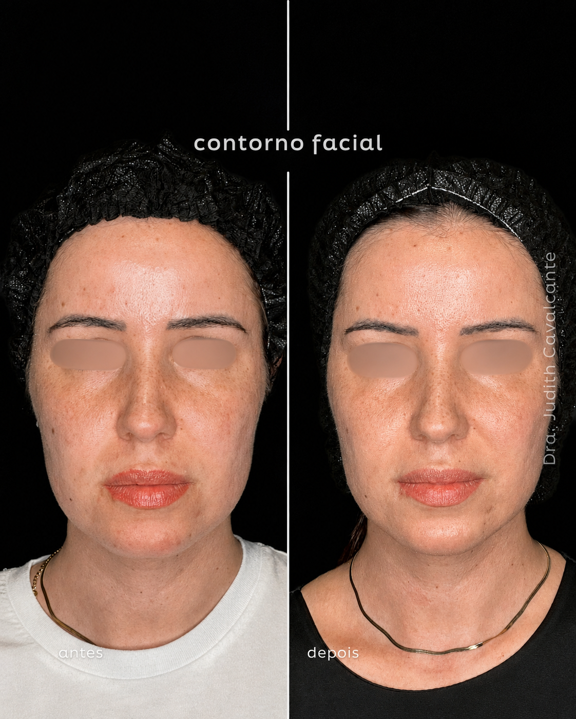 Contorno Facial