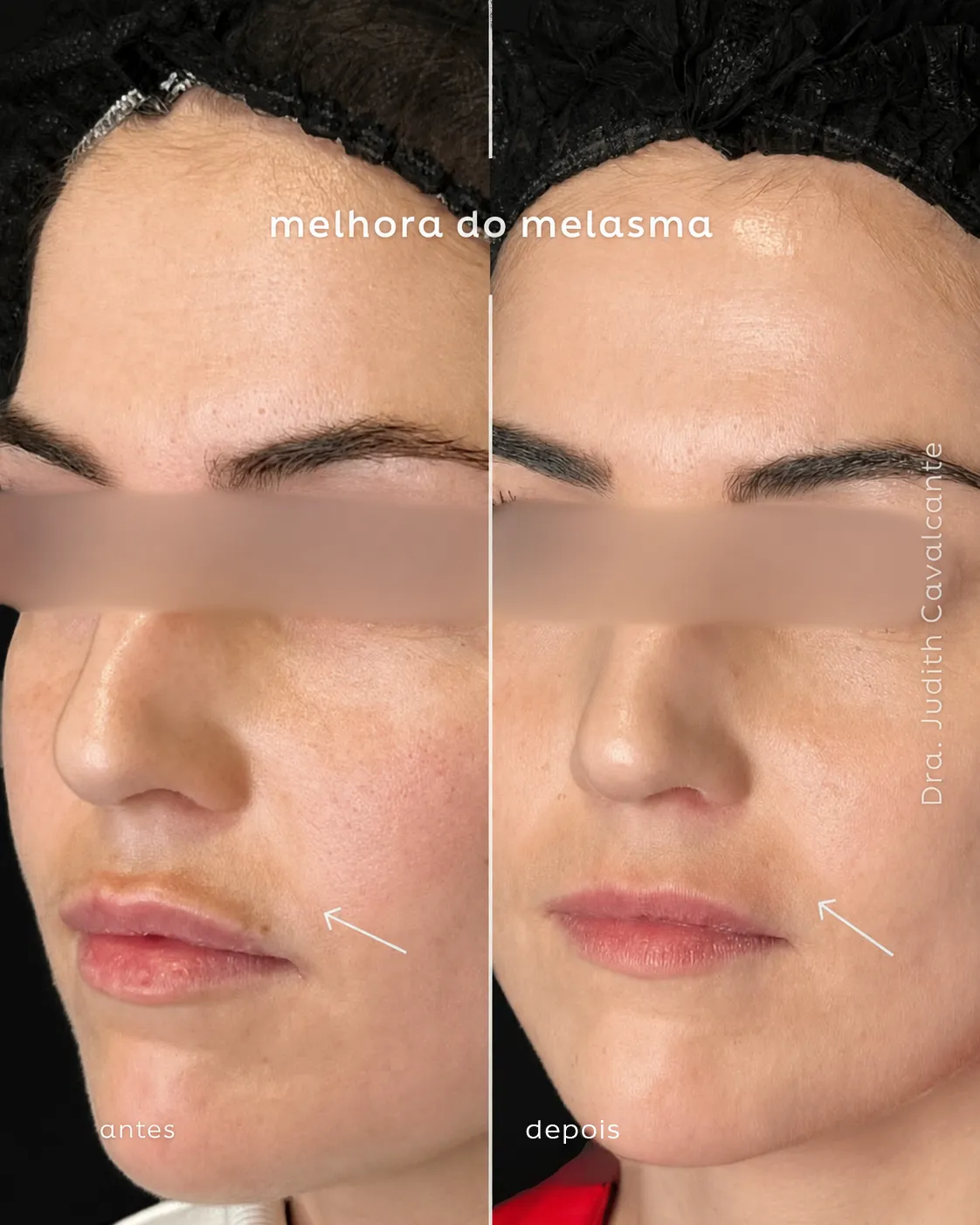 Melasma