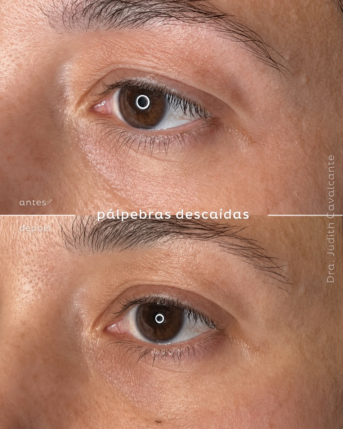 Pálpebras descaídas