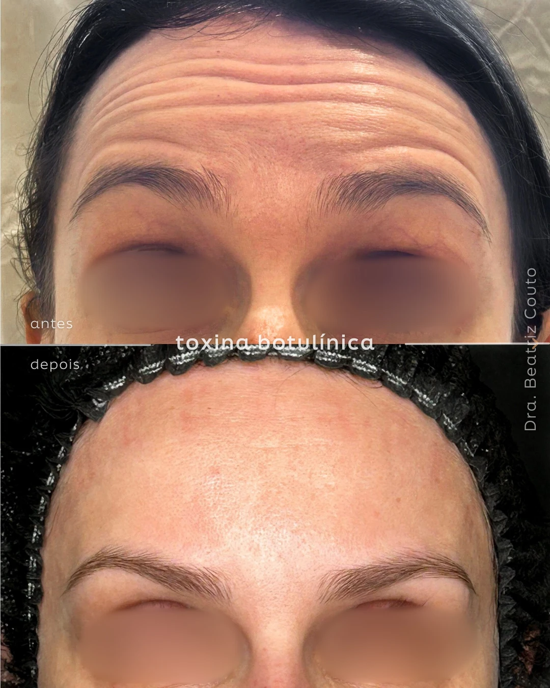 Botox testa