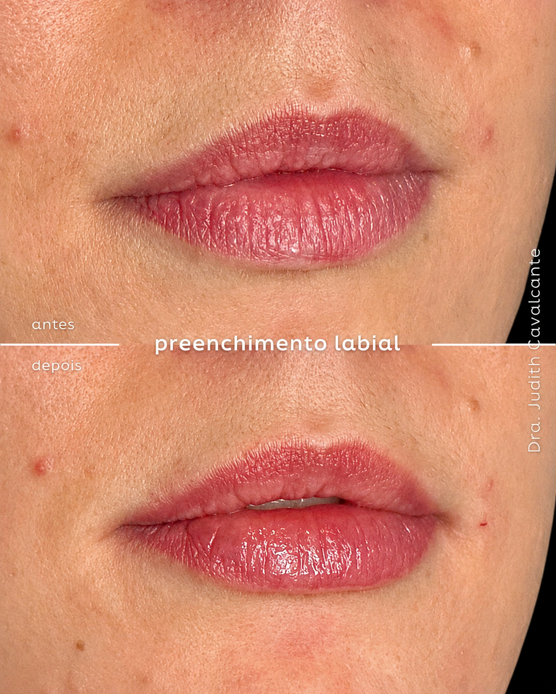 Preenchimento Labial