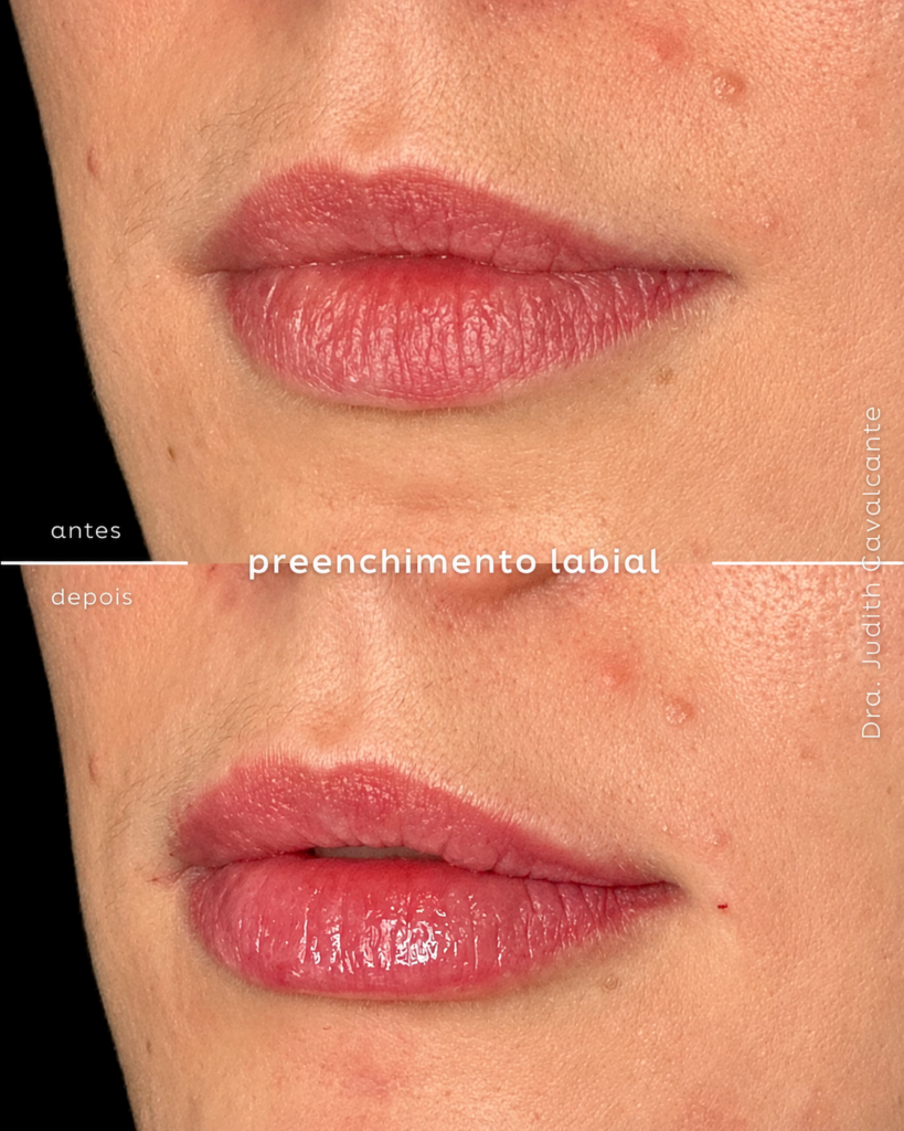 Preenchimento Labial