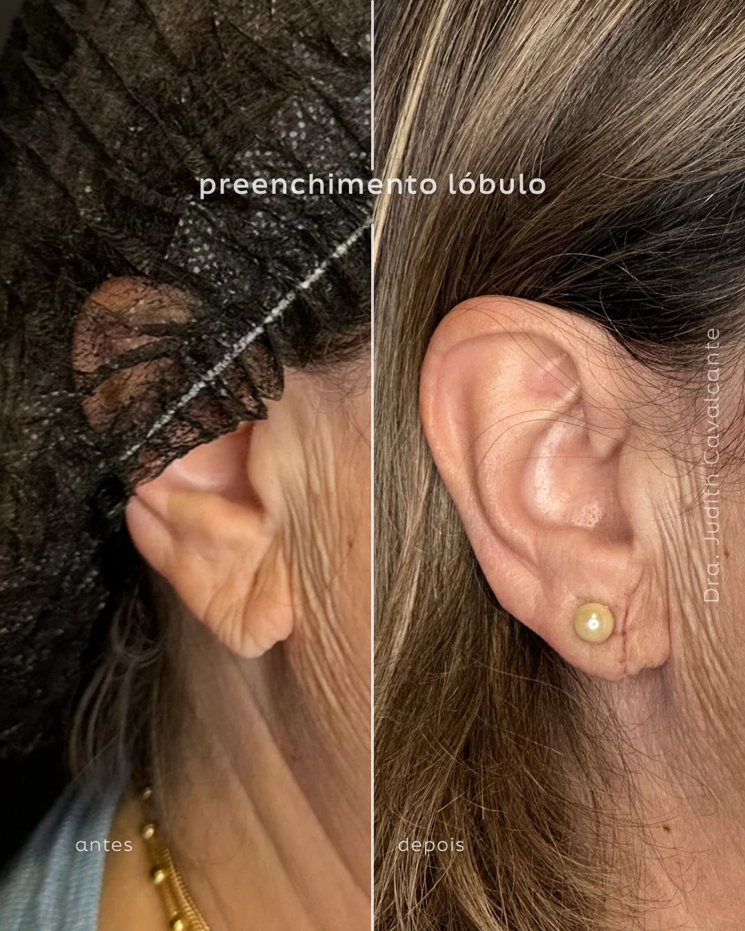 Preenchimento lóbulo