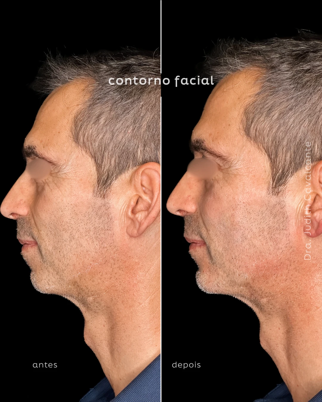 Contorno facial Masculino