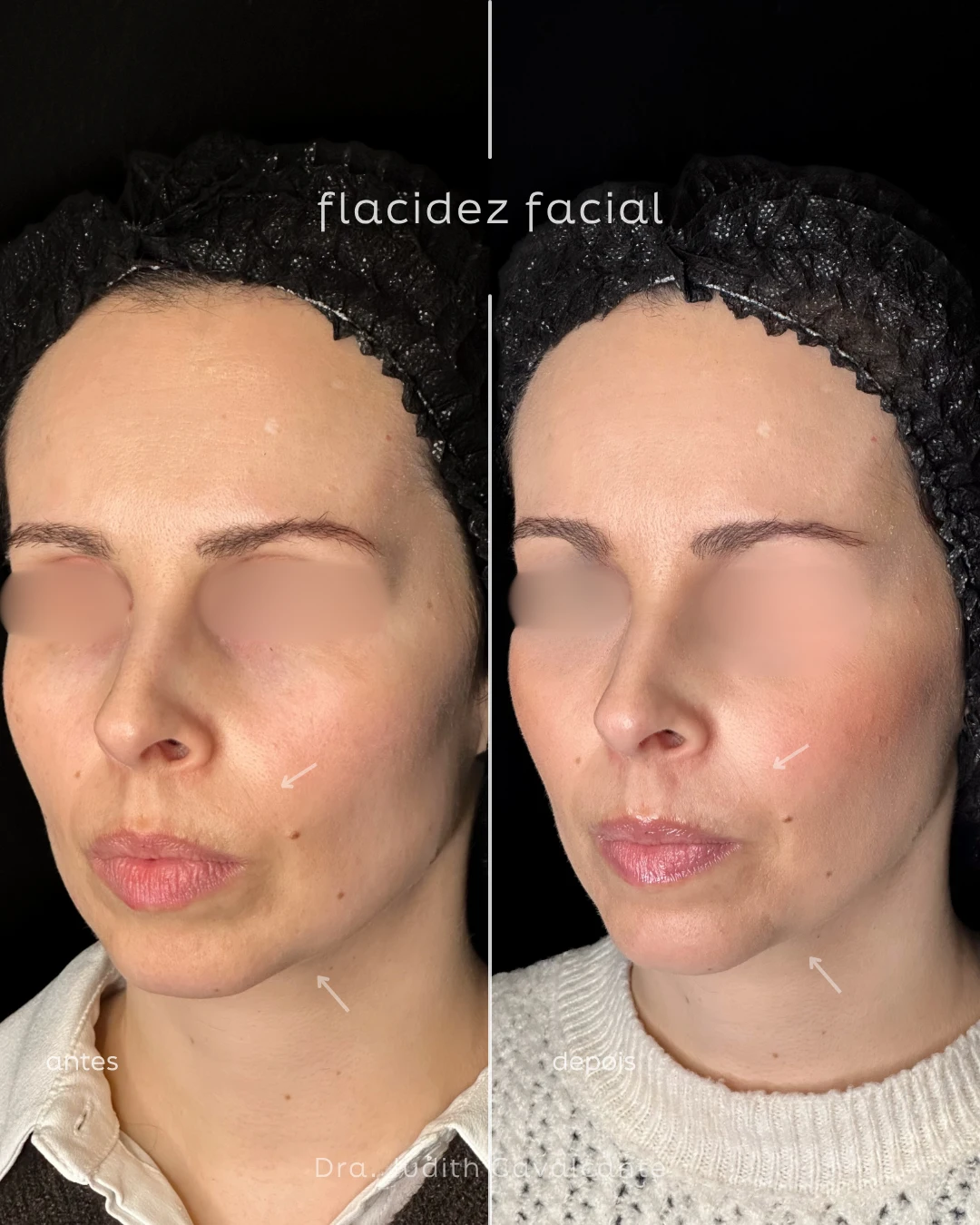 Flacidez facial