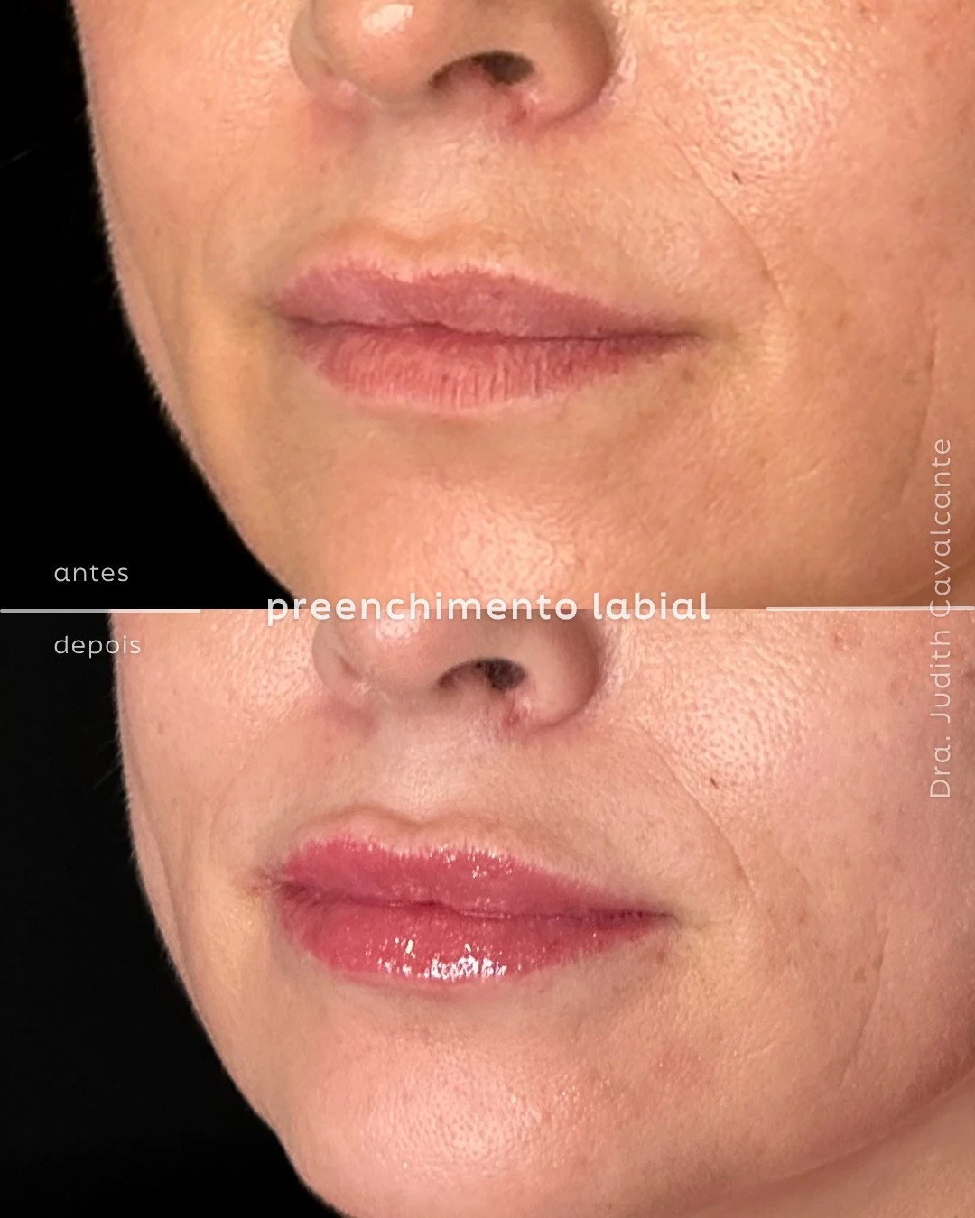 Preenchimento labial