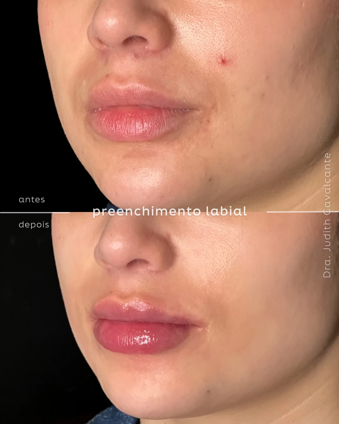 Volume labial