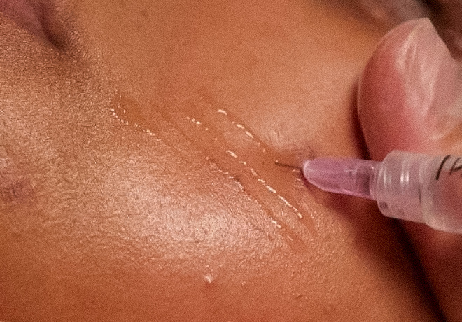 Mesoterapia