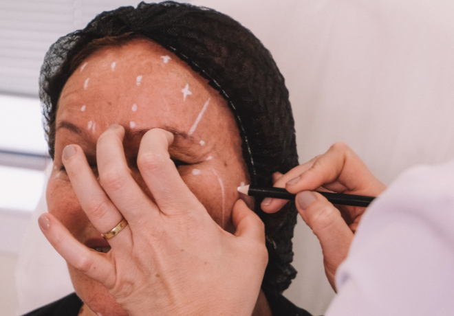 Botox Terço Superior