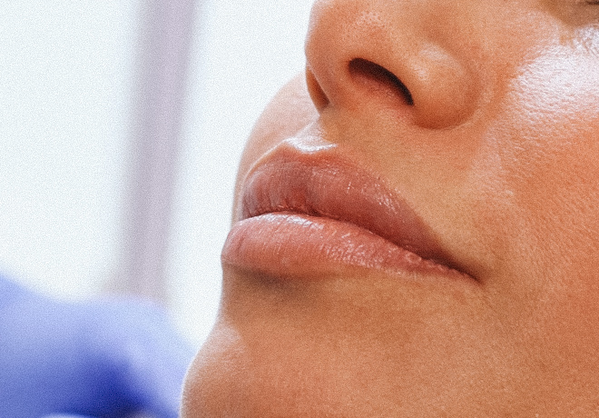 Preenhcimento Labial