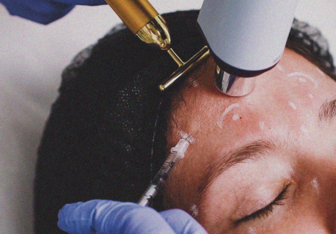 Botox Terço Superior
