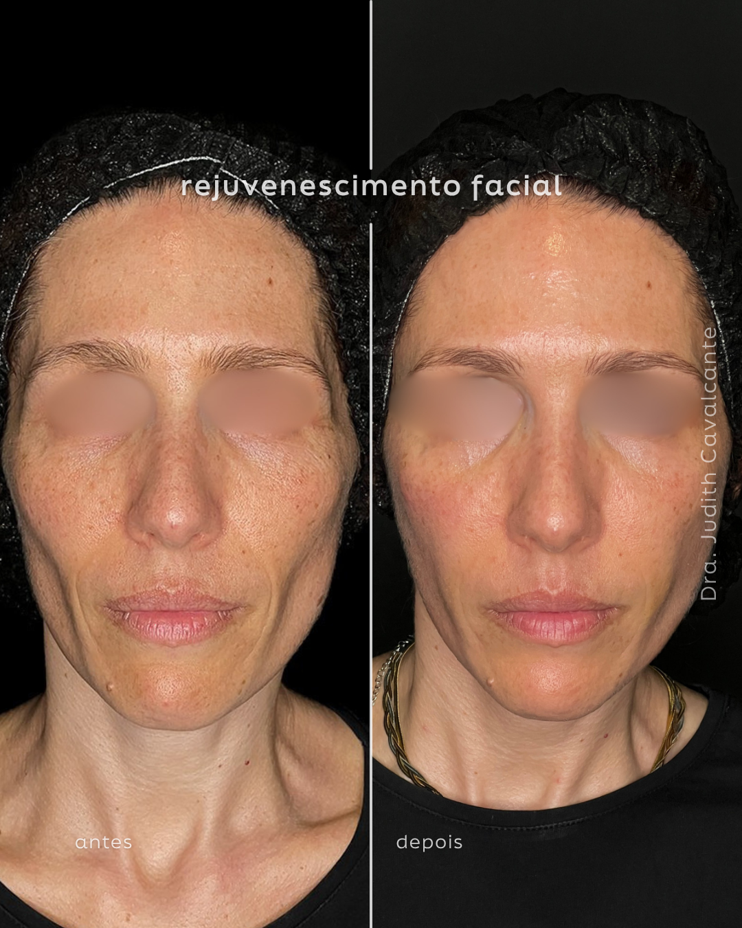 Rejuvenescimento Facial 01