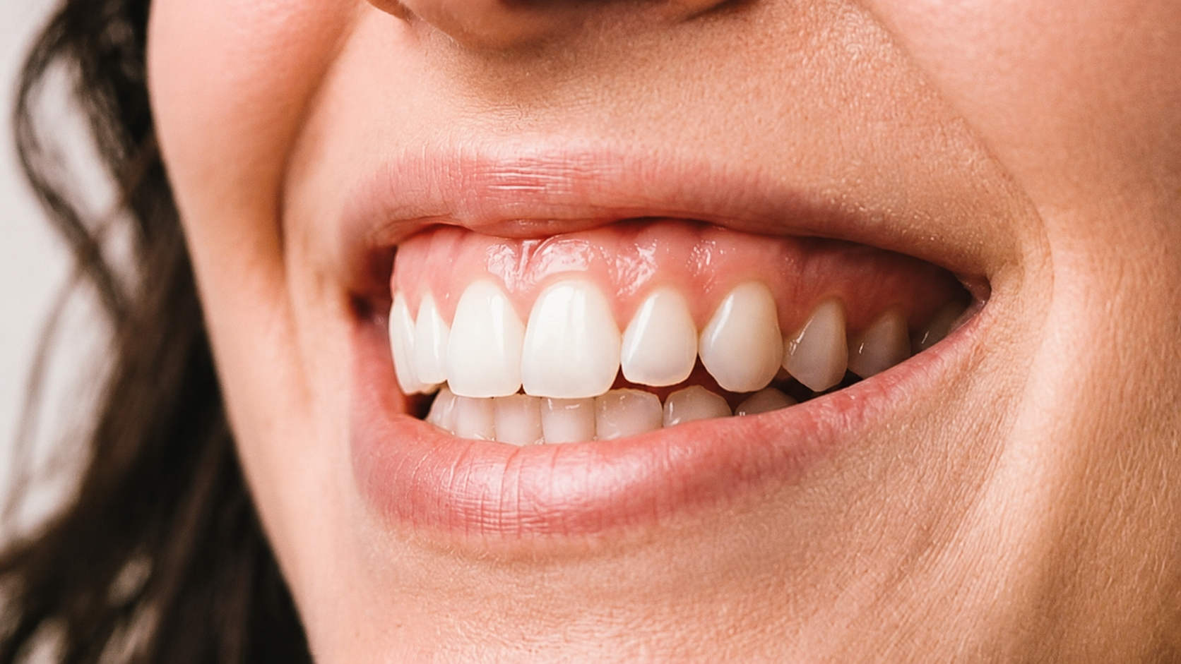 Sorriso Gengival