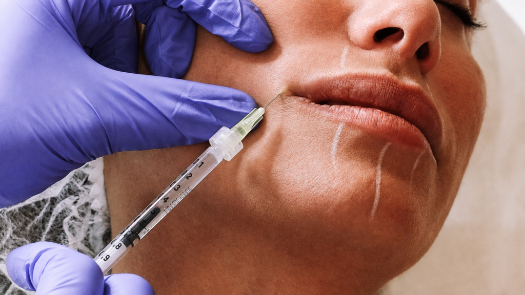 Preenchimento Labial com agulha