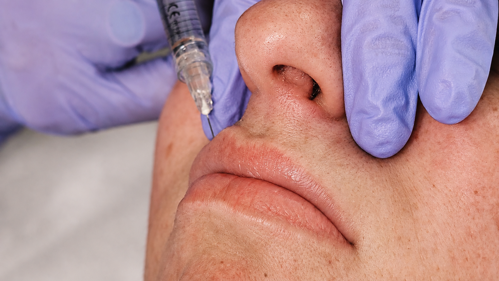 Preenchimento Labial