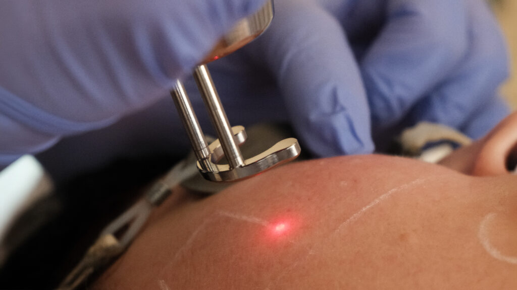 Laser Face