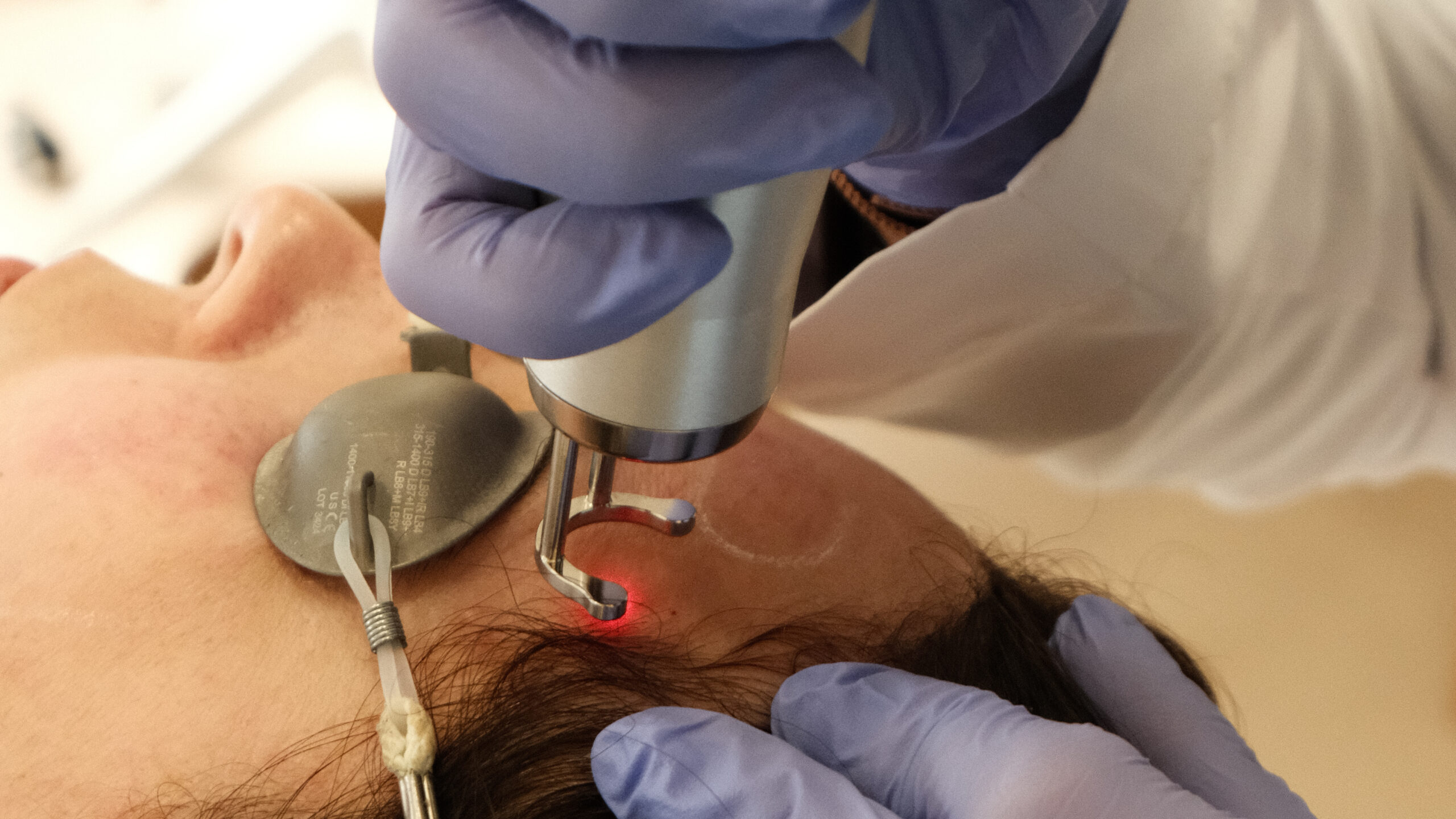 Laser Rejuvenescimento 3