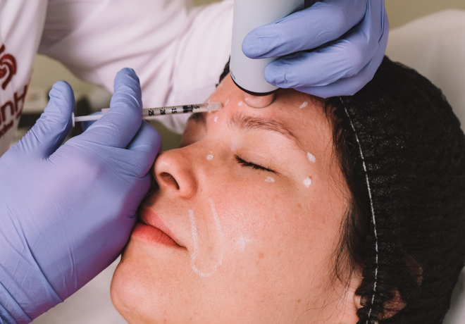 Botox Terço Superior