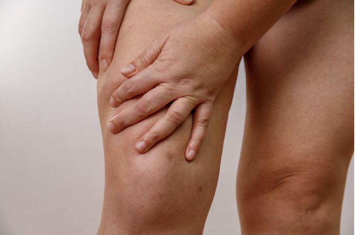 Lipedema