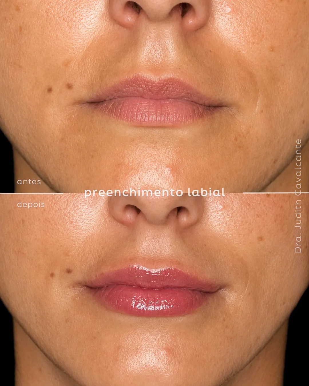 Preenchimento labial 1