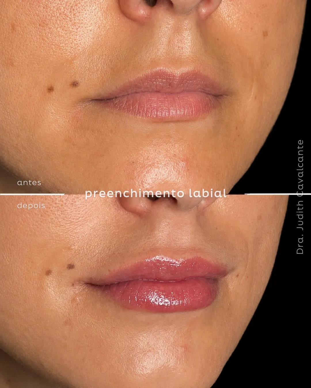 Preenchimento labial 2