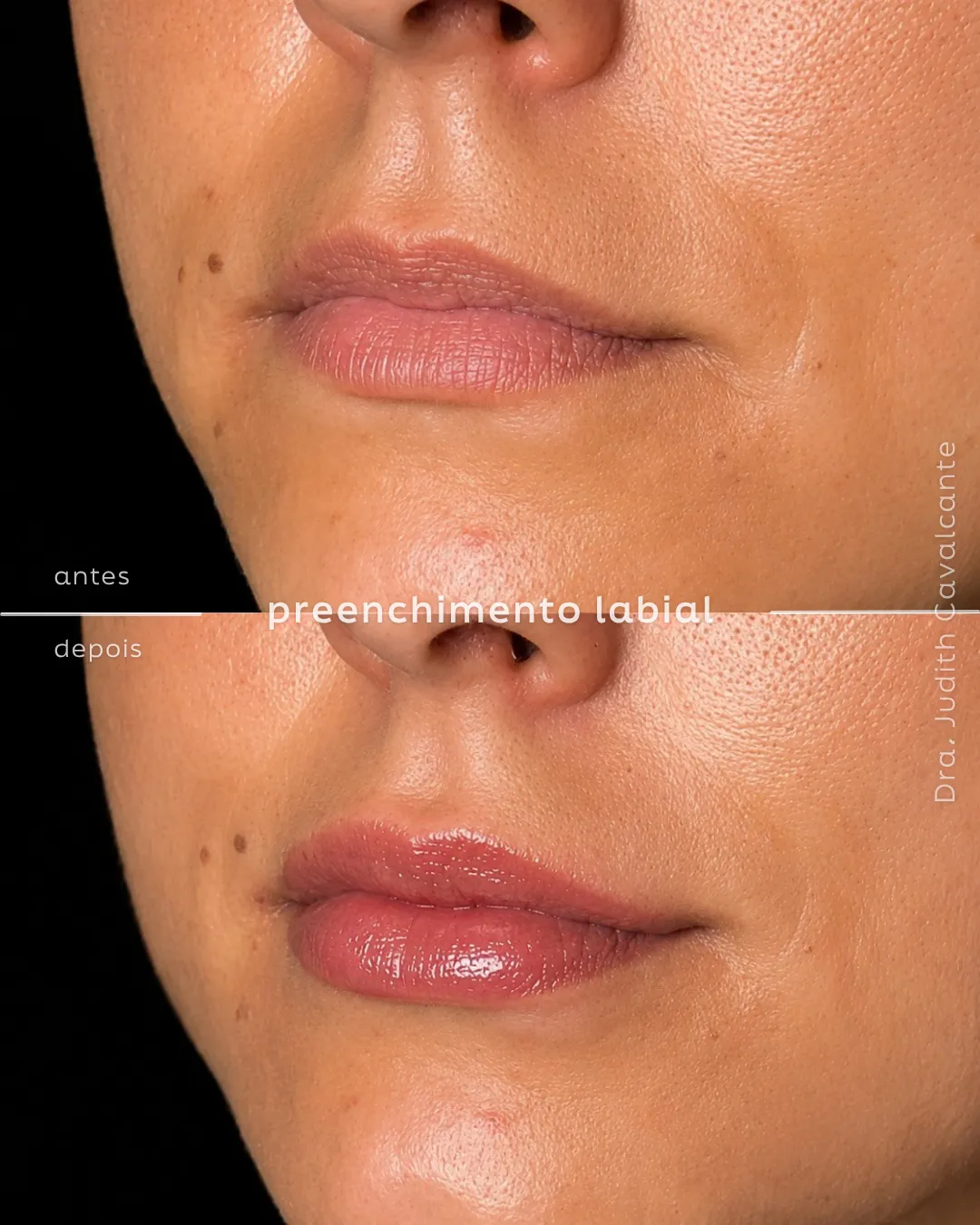 Preenchimento labial 3